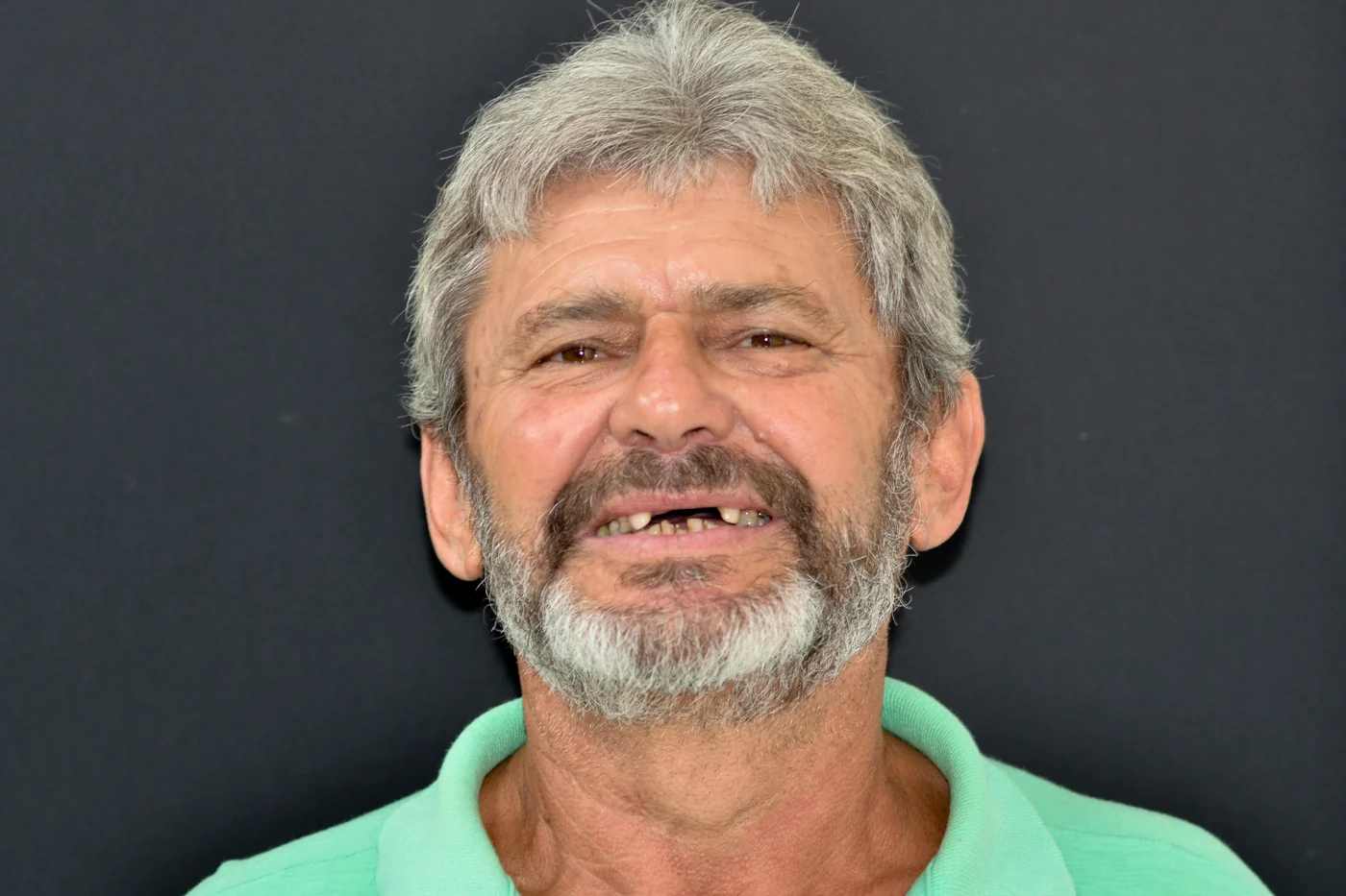 Antes do tratamento — caso 04